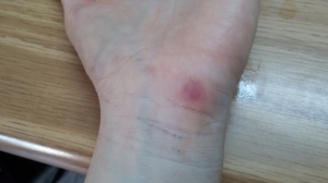 Eight days post injury. The wound has practically healed. Almost no pain is left. 